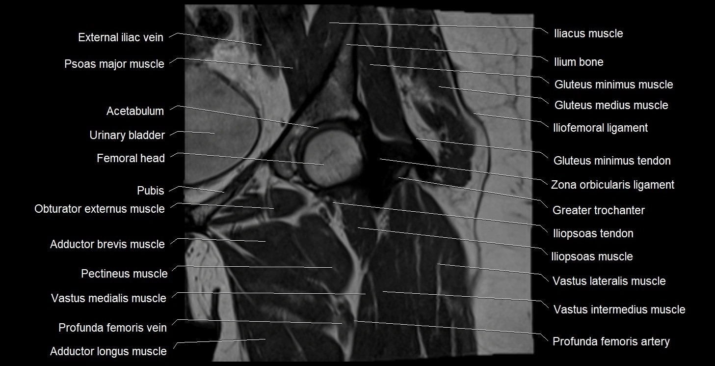 MRI Hip 3T coronal cross sectional anatomy image 25.webp